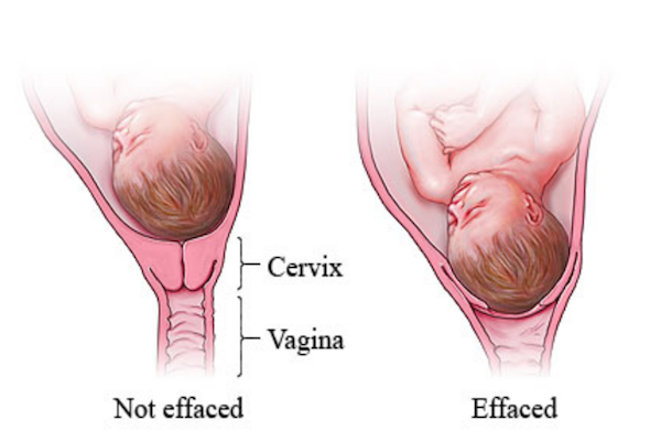 Cervical Length Chart Twins