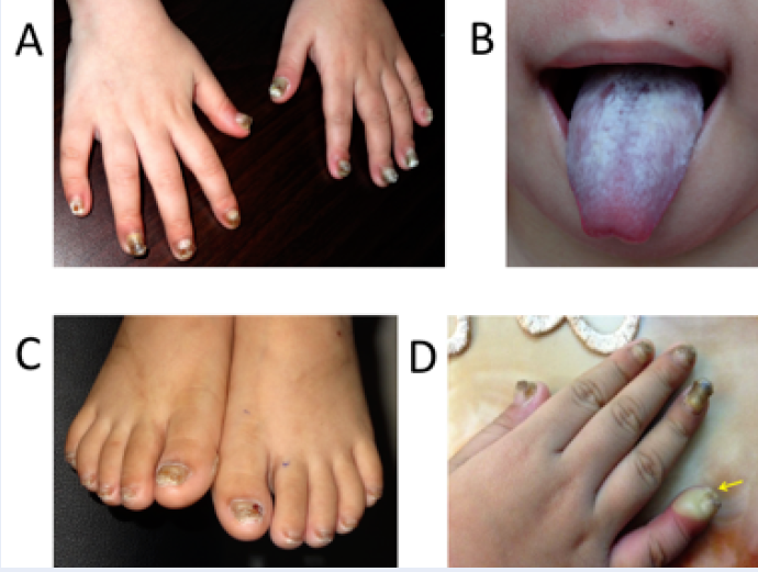 Figure 2. [Dorsal (A) and palmar (B)]. - GeneReviews® - NCBI Bookshelf